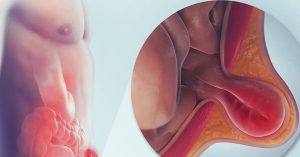 Read more about the article Homeopathy Medicine For Hernia Effectiveness, Benefits And Limitations